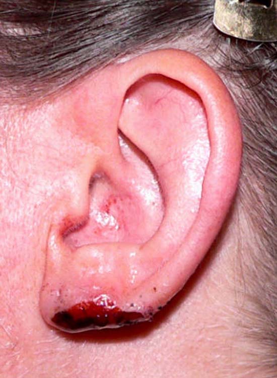 ear-oct-2006-postop
