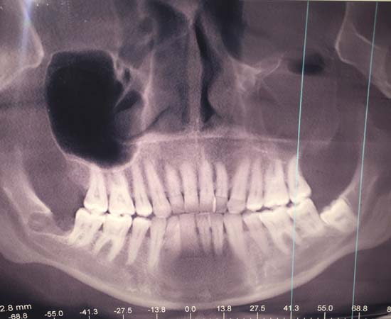 wisdom teeth surgery x-ray