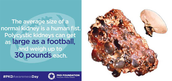 The average size of normal kidney is a human fist. Polycystic kidneys can get as large as a football, and weigh up to 30 pounds each. Image of regular vs PKD kidney